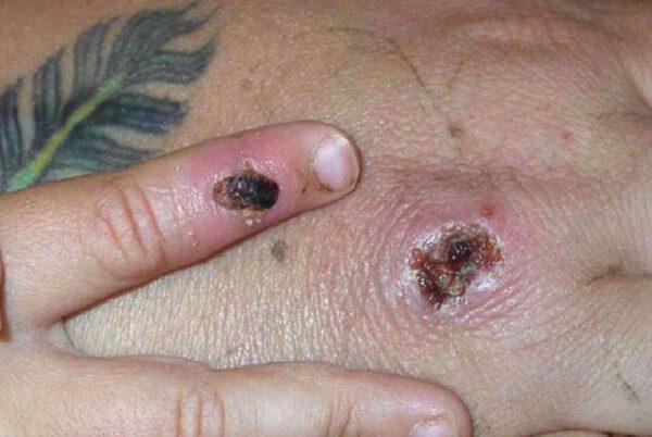 Симптомы оспы обезьян показаны на руке пациента 5 июня 2003 года. (CDC/Getty Images)