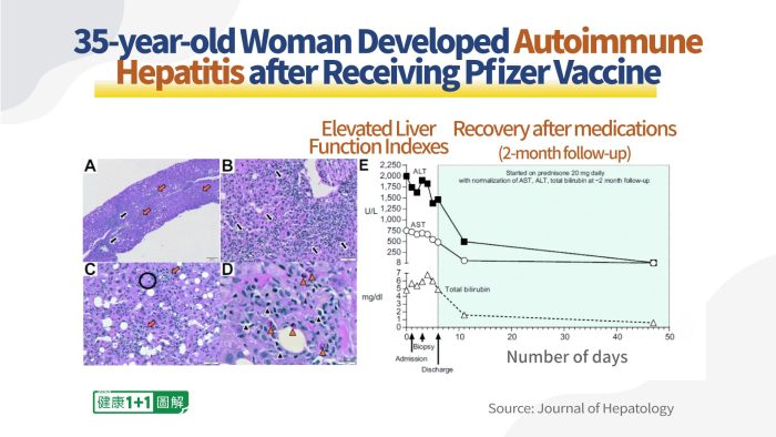 Исцеление от аутоиммунитета и гепатита, вызванных вакцинацией от COVID-19